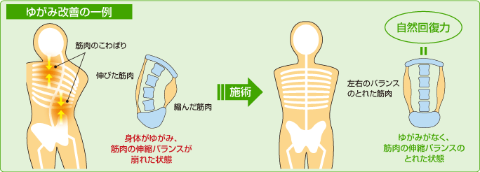 ゆがみ改善の一例