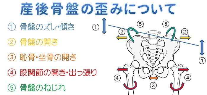 骨盤の歪みについて