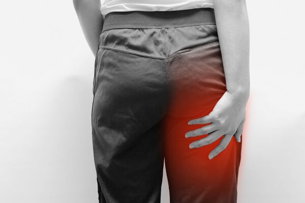 坐骨神経痛で臀部から大腿部に痛みがある女性