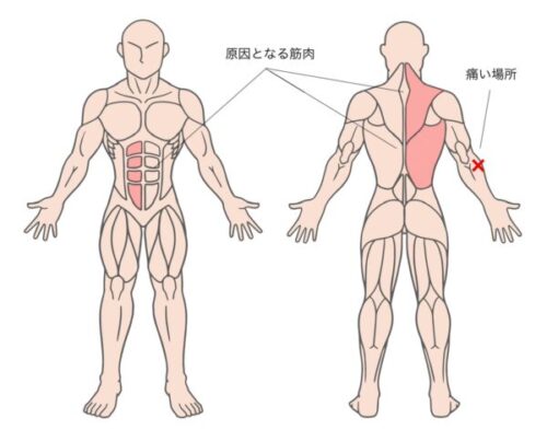 原因筋と痛みの部位